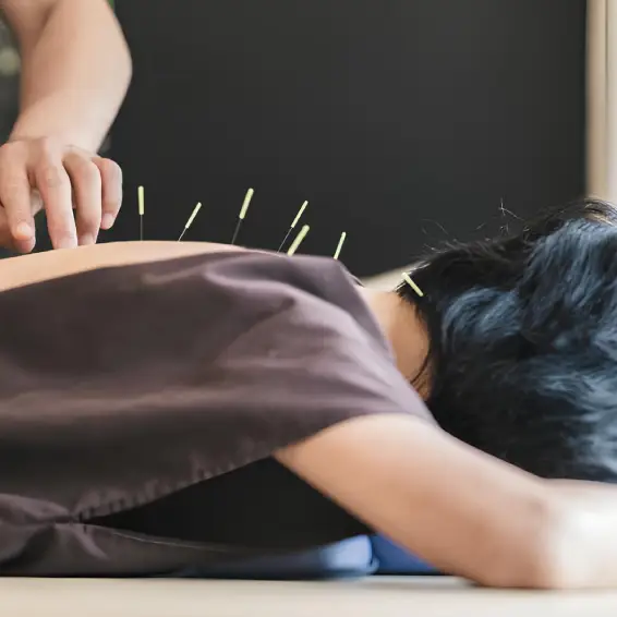 Acupuncture